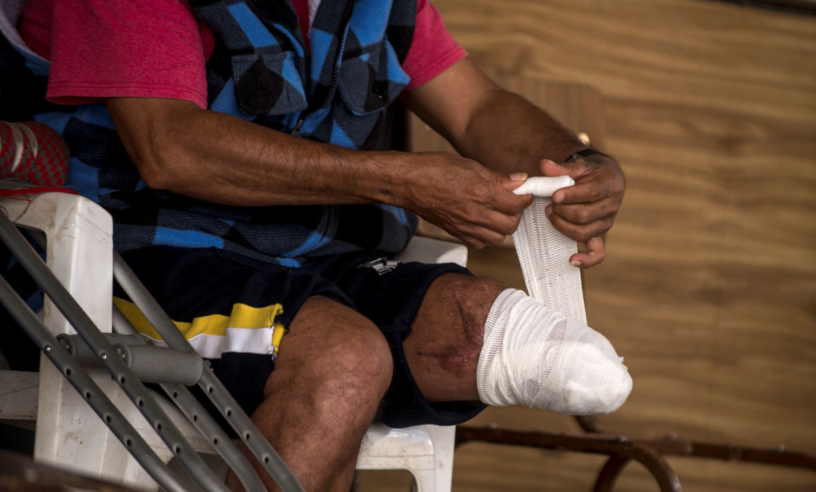 Un migrante centroamericano, que ha perdido la pierna viajando sobre el lomo del tren 