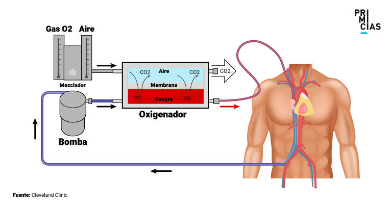 Proceso de oxigenación mediante una membrana extracorporal o ECMO