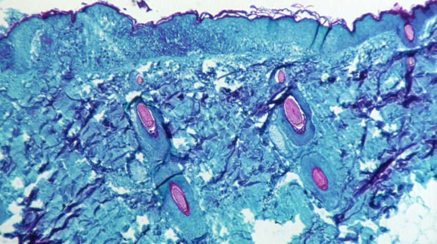 Imagen microscópica de una parte de la piel contagiada con la viruela del mono. 