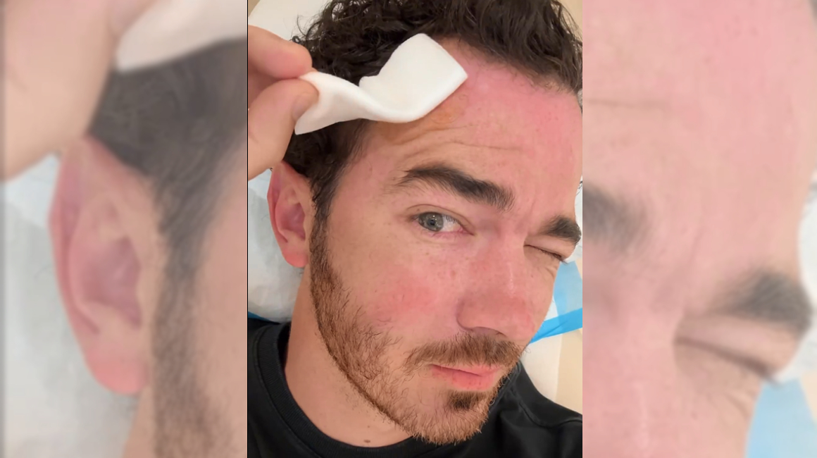 Kevin Jonas muestra en un video subido a Instagram los resultados de una operación por cáncer de piel.
